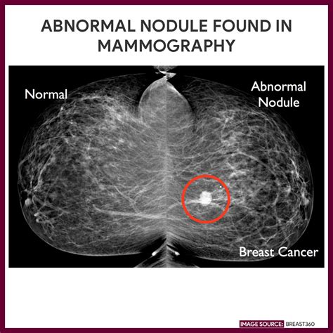 Mammogram images: Normal, abnormal, and breast cancer .